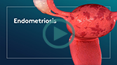 What is Endometriosis?